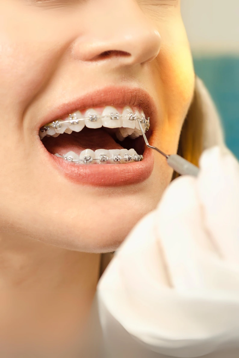 Orthodontics Braces
