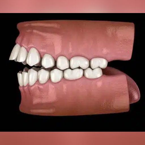 Open Bite
