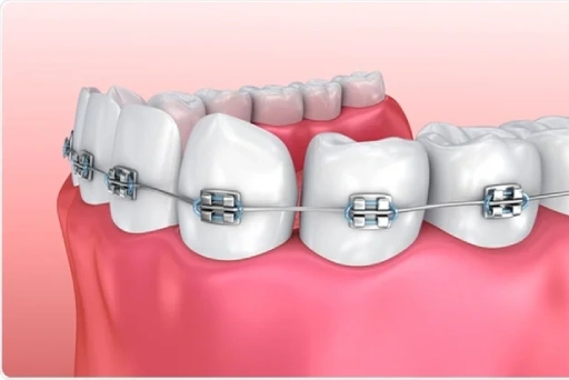 Traditional Braces