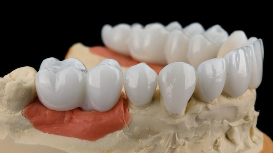 About Natural Laminate Veneers