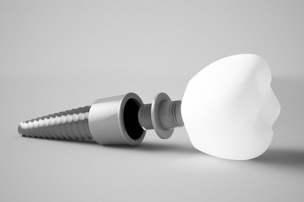 The Impact of Missing Teeth on Oral Health