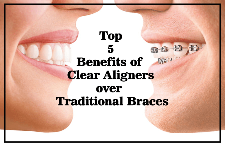 Top 5 Benefits of Clear Aligners over Traditional Braces