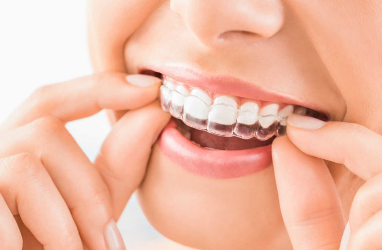 The Evolution of Orthodontic Treatments: From Braces to Clear Aligners