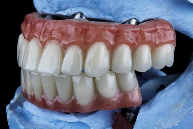 All-On-4 Dental Implants in Dubai: A Revolutionary Solution for a Complete Smile