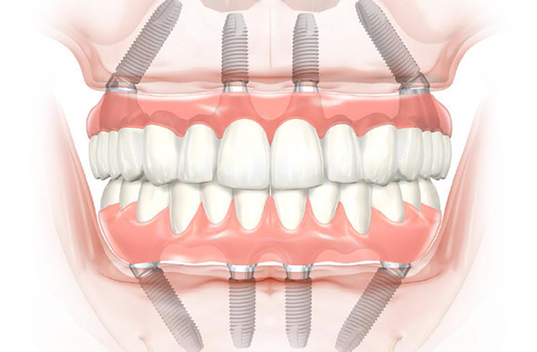 How to care for your Dental Implants: Tips for long-lasting results.